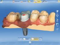 CEREC AC OMNICAM ПРОСТОЕ СКАНИРОВАНИЕ БЕЗ АНТИБЛИКОВОГО СПРЕЯ 19.jpg CEREC AC OMNICAM ПРОСТОЕ СКАНИРОВАНИЕ БЕЗ АНТИБЛИКОВОГО СПРЕЯ 19.jpg